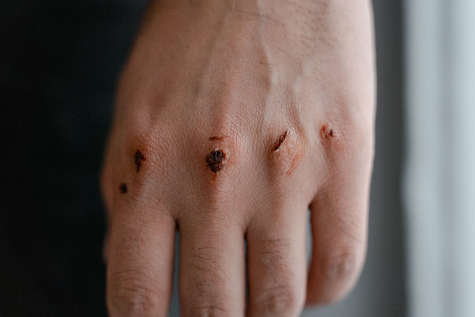 Cicatrices y lesiones visibles en los nudillos de una mano.